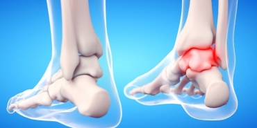 Ayak Bileği Ağrısı (2)