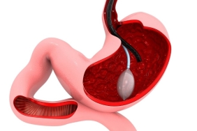 antalya mide balonu (2)