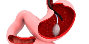 antalya mide balonu (2)