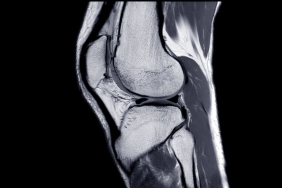 haglund deformitesi ameliyatı​ (2)