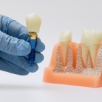 implant tedavisi (3)