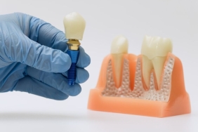 implant tedavisi (3)