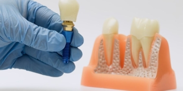 implant tedavisi (3)