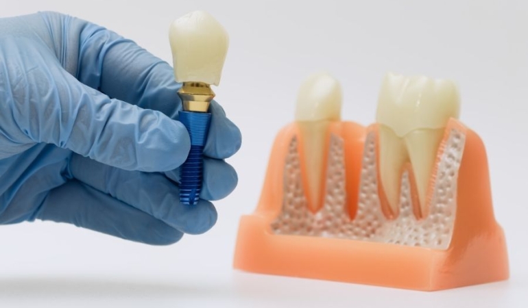 implant tedavisi (3)